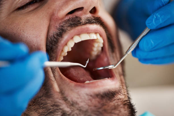 Best Emergency Wisdom Teeth Removal in Medina, TN